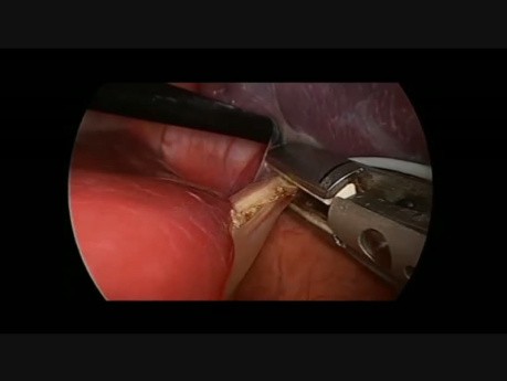 Esplenectomía laparoscópica en niño    