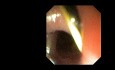 Divertículo cricofaríngeo congénito con rotura y formación de fístula cervical