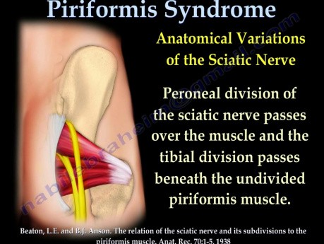 Síndrome del piriforme - video-сlase