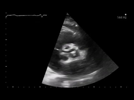 Α prueba de ecocardiografía simple 