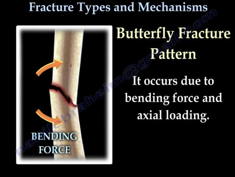 Tipos y mecanismos de las fracturas de huesos