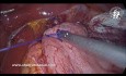 Fundoplicatura Dor en Acalasia