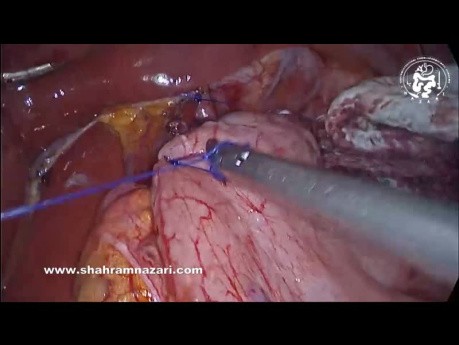 Fundoplicatura Dor en Acalasia