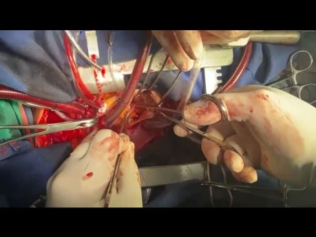 Paciente con SAI adherida al tabique sometida a resección septal extensa con márgenes seguros