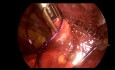 Reparación de la brecha peritoneal durante la cirugía TEP