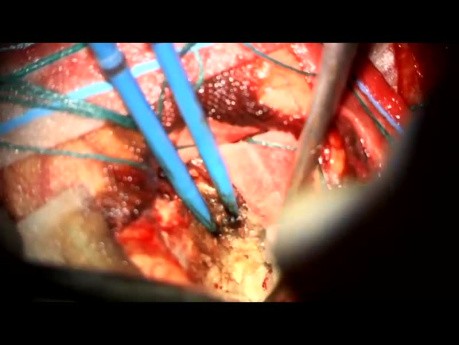 Craneotomía occipital izquierda y resección de meningioma parafalciforme de gran tamaño