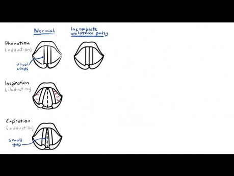 Parálisis del nervio laríngeo (anatomía, fisiología, clasificación, causas, fisiopatología)