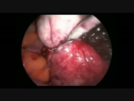 Miomectomía posterior amplia laparoscópica