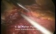 Gastrectomía total con resección D2 - abordaje laparoscópico