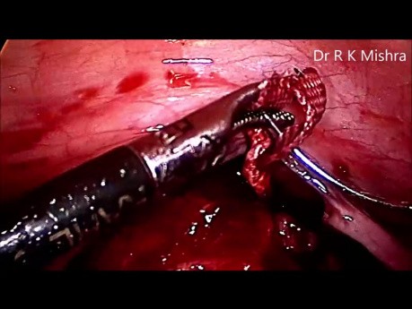 Cerclaje Cervical por vía Laparoscópica