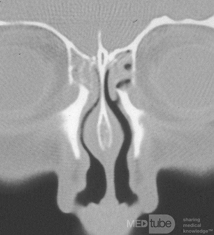 El cuerpo hinchado del tabique nasal