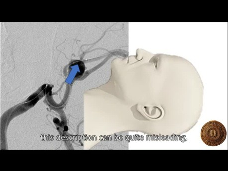 Dirección del fondo de ojo aneurismático