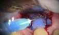 Corección del cubrimiento radicular - microcirugía periodontológica