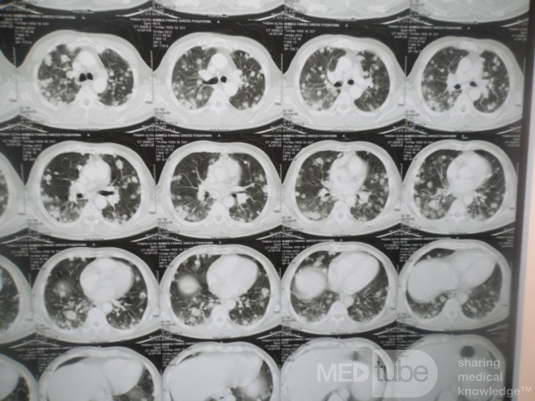 Metástasis torácica debida a carcinoma de células renales 1