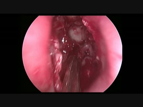 Extirpación de osteoma del seno frontal en técnica Draf IIB