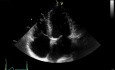 La enfermedad renal crónica como principal motivo de calcificación de la válvula aorto-mitral