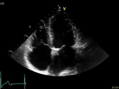 La enfermedad renal crónica como principal motivo de calcificación de la válvula aorto-mitral