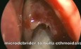Cirugía endoscópica nasosinusal - mucocele etmoide