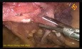 Colectomía derecha laparoscópica con escisión mesocólica completa
