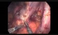 Resección laparoscópica de GIST duodenal