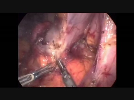 Resección laparoscópica de GIST duodenal