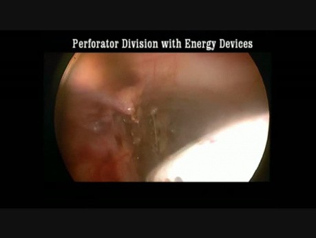 Ligadura endoscópica subfascial de perforantes