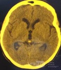 Tercera ventriculostomía endoscópica en un caso benigno de síndrome de Aicardi con hidrocefalia obstructiva y malformación de Chiari tipo 1