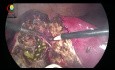 Desgarro de la vesícula biliar durante la colecistectomía laparoscópica