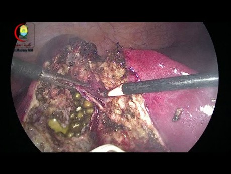 Desgarro de la vesícula biliar durante la colecistectomía laparoscópica