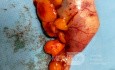 Extirpación laparoscópica de una neoplasia apendicular