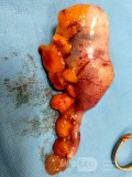 Extirpación laparoscópica de una neoplasia apendicular