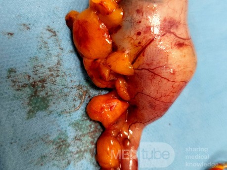 Extirpación laparoscópica de una neoplasia apendicular