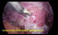 Histerectomía total laparoscópica - Útero fibroide