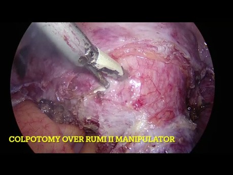 Histerectomía total laparoscópica - Útero fibroide