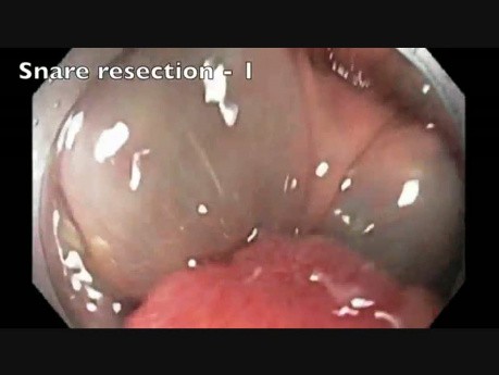 Extirpación de un pólipo del colon ascendente, microperforación