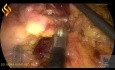 Colectomía derecha laparoscópica con linfadenectomía D2