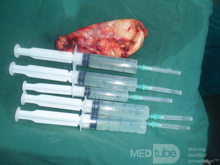 Colecistitis aguda eliminada por colecistectomía laparoscópica