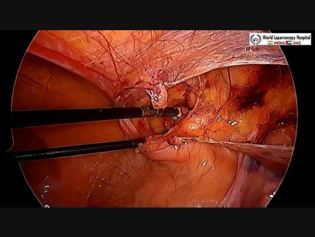 Reparación laparoscópica de hernia inguinal en mujeres