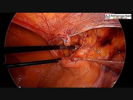 hernia inguinal anatomía femenina