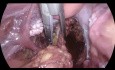 Resección anterior laparoscópica para el cáncer de colon