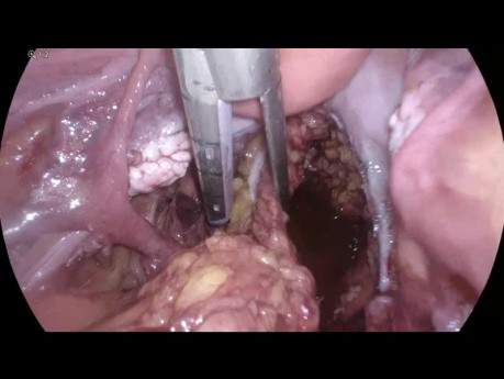Resección anterior laparoscópica para el cáncer de colon