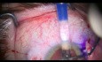 Fijación intraescleral de Carlevale combinada con disminución del tamaño de la pupila