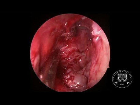 Resección de papiloma invertido (video HD)