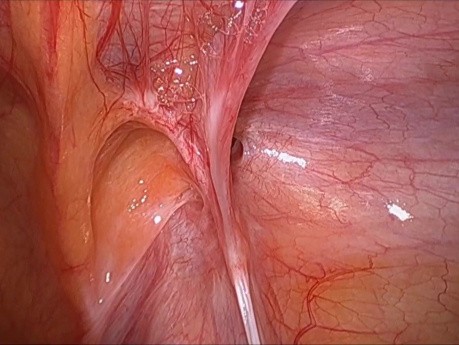 Operación de una hernia inguinal oblicua con entrada estrecha por el método TAPP usando una malla 3DMax