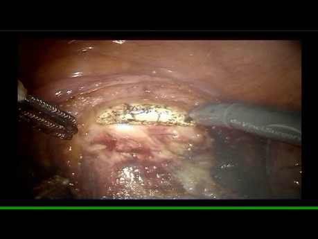 Histerectomía robótica Disección de ganglios linfáticos