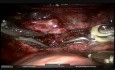 Segmentectomía anatómica S2 - cirugía robótica