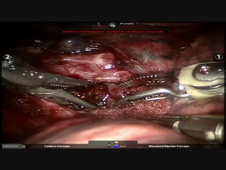 Segmentectomía anatómica S2 - cirugía robótica