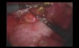 Extirpación laparoscópica de un cuerpo extraño perforado que imita una apendicitis aguda perforada 