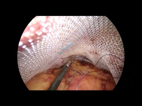 Técnicas de sutura en la reparación laparoscópica transabdominal preperitoneal (TAPP) de la hernia inguinal