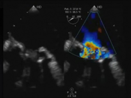 Un caso: Endocarditis infecciosa de una válvula mitral protésica ecocardiografía transesofágica